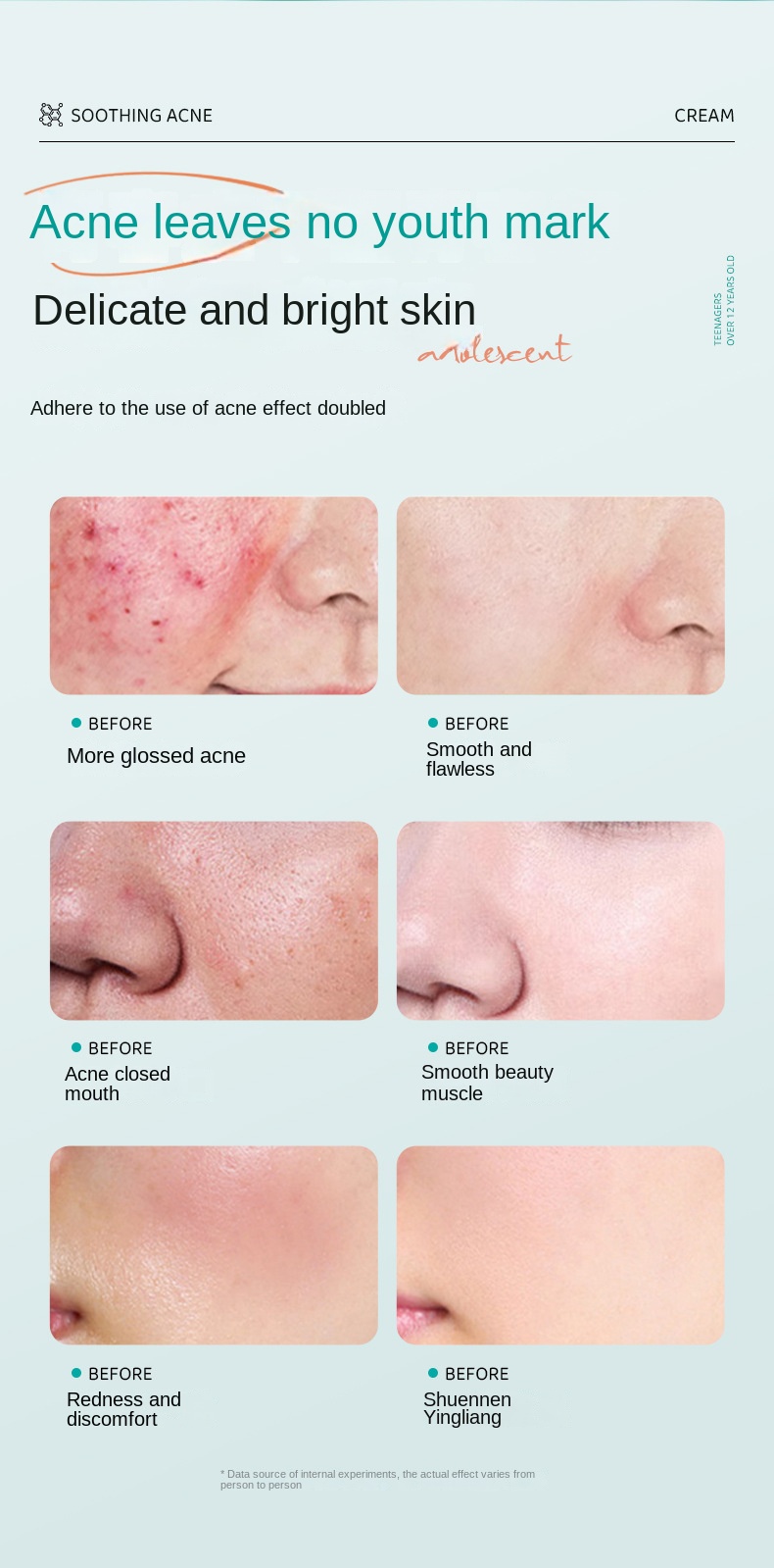 Teenagers' Soothing Acne Cream